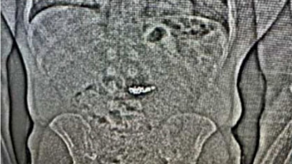 Diamond Tiffany earrings swallowed by suspected thief are recovered by Florida police Diamond Tiffany earrings swallowed by suspected thief are recovered by Florida police