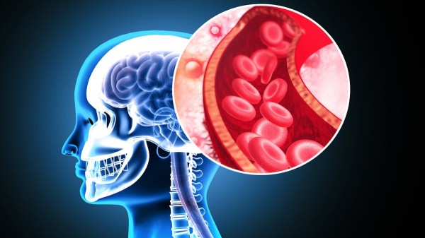 Stanford researchers develop &lsquo;game-changing&rsquo; stroke treatment that doubles effectiveness