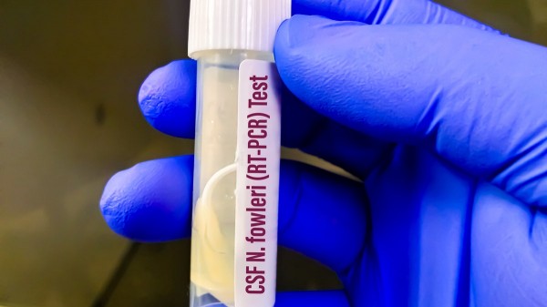 Woman dies of brain-eating amoeba after using tap water in nasal rinse device Woman dies of brain-eating amoeba after using tap water in nasal rinse device