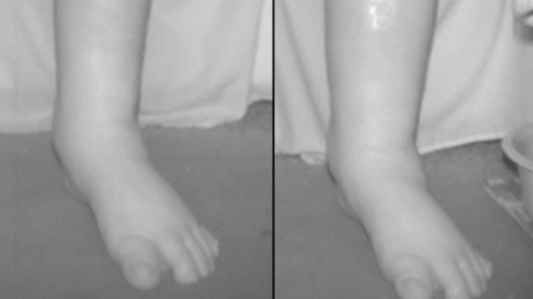 AI foot scanner recognises warning signs of heart failure to keep people out of hospital, researchers say