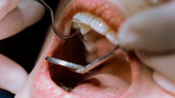 Most common causes of cavities in the teeth — and how to prevent them Most common causes of cavities in the teeth — and how to prevent them