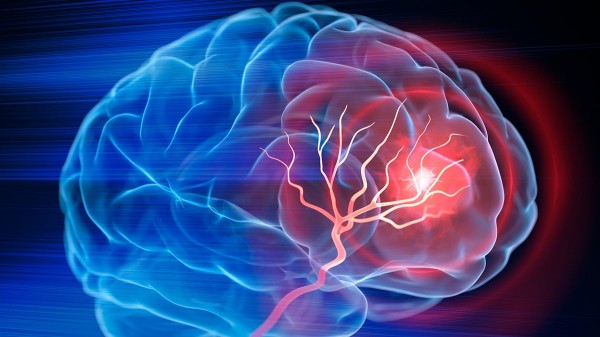 Stanford researchers develop &lsquo;game-changing&rsquo; stroke treatment that doubles effectiveness