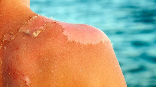 Sunburn isn't just red skin - here's what's happening underneath the burn