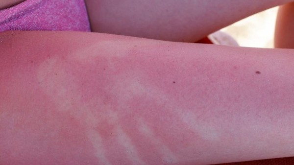 Sunburn isn't just red skin - here's what's happening underneath the burn