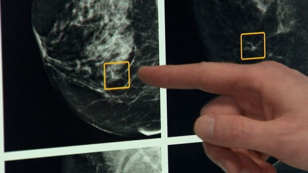 'Transformational' new drug could stop breast cancer tumours before they grow, trial finds