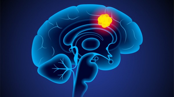 Man's deadly brain cancer tumor disappears after experimental drug trial Man's deadly brain cancer tumor disappears after experimental drug trial