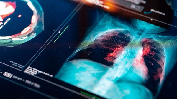 Never smoked? You could still be at risk of developing lung cancer, doctors warn