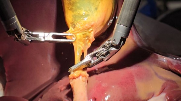 Robot performs realistic gallbladder surgery 'with 100% accuracy' Robot performs realistic gallbladder surgery 'with 100% accuracy'
