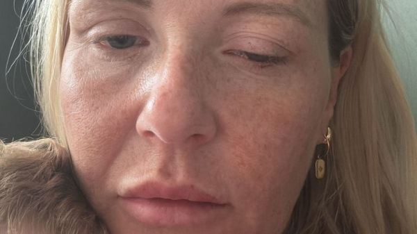 Unlicensed Botox-like injections spark outbreak of disease many doctors have never treated Unlicensed Botox-like injections spark outbreak of disease many doctors have never treated
