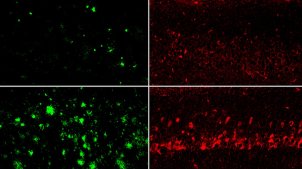 'Missing link' to Alzheimer's disease found in study of human brain tissue 'Missing link' to Alzheimer's disease found in study of human brain tissue
