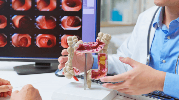 Colorectal cancer diagnoses soar among younger adults for one key reason Colorectal cancer diagnoses soar among younger adults for one key reason