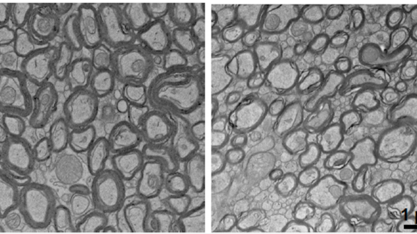 'Missing link' to Alzheimer's disease found in study of human brain tissue 'Missing link' to Alzheimer's disease found in study of human brain tissue