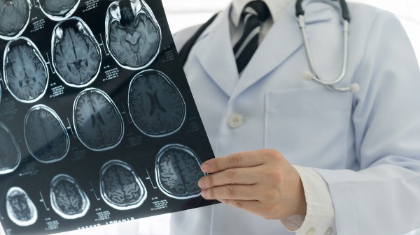Early Alzheimer&rsquo;s signs detected in 3 minutes with new brainwave test