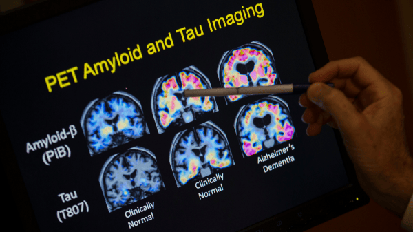 He carries the Alzheimer’s gene but never got the disease — scientists want to know why He carries the Alzheimer’s gene but never got the disease — scientists want to know why