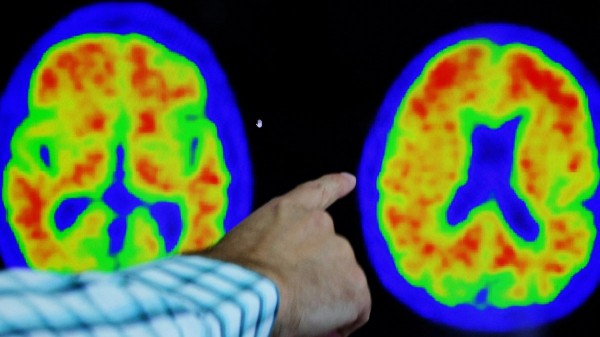 He carries the Alzheimer’s gene but never got the disease — scientists want to know why He carries the Alzheimer’s gene but never got the disease — scientists want to know why