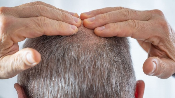 Hair-loss drug tied to suicides, depression and anxiety in global study