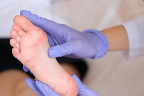 Minnesota reports 10 new measles cases in unvaccinated travelers Minnesota reports 10 new measles cases in unvaccinated travelers