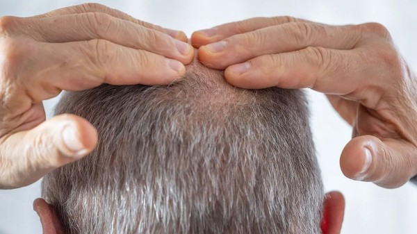 New baldness treatment shows dramatic hair-regrowth gains in major trial New baldness treatment shows dramatic hair-regrowth gains in major trial