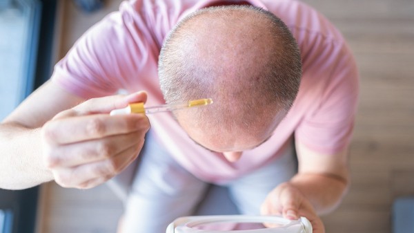 New baldness treatment shows dramatic hair-regrowth gains in major trial New baldness treatment shows dramatic hair-regrowth gains in major trial