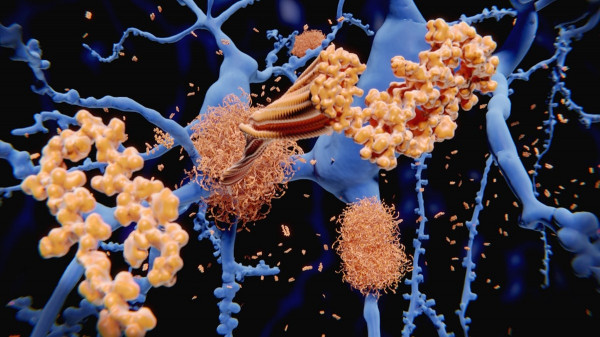 Alzheimer’s disease could be reversed by restoring brain balance, study suggests Alzheimer’s disease could be reversed by restoring brain balance, study suggests