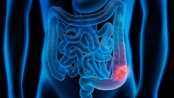Deadly cancer risk spikes with certain level of alcohol consumption, study finds Deadly cancer risk spikes with certain level of alcohol consumption, study finds