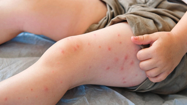 Measles outbreak poses risk of 'irreversible' brain damage, health officials warn Measles outbreak poses risk of 'irreversible' brain damage, health officials warn